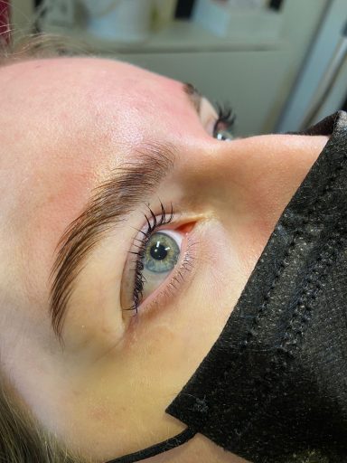 Brow lift 