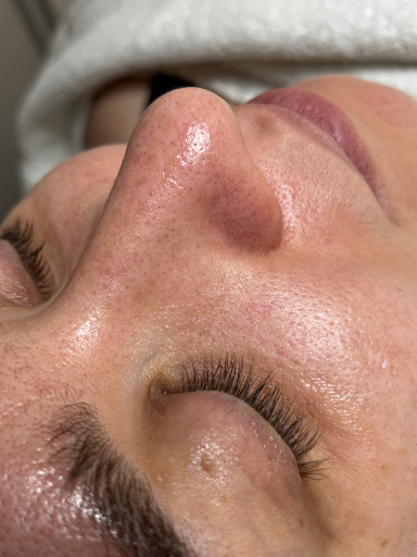 Avant hydrafacial