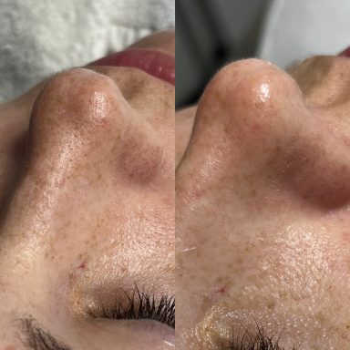 Avant/après hydrafacial